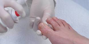 grzybica paznokci jak leczyć