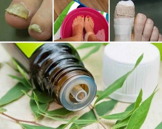 Tree Tree for Nails Fungus