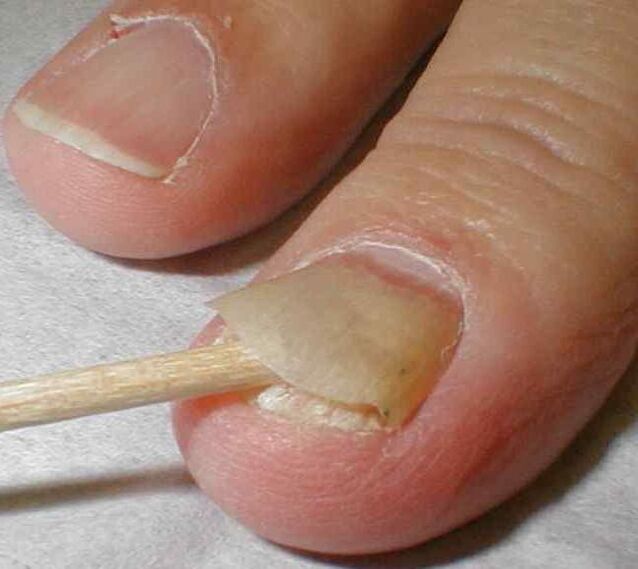 złuszczanie się paznokcia z grzybicą paznokci