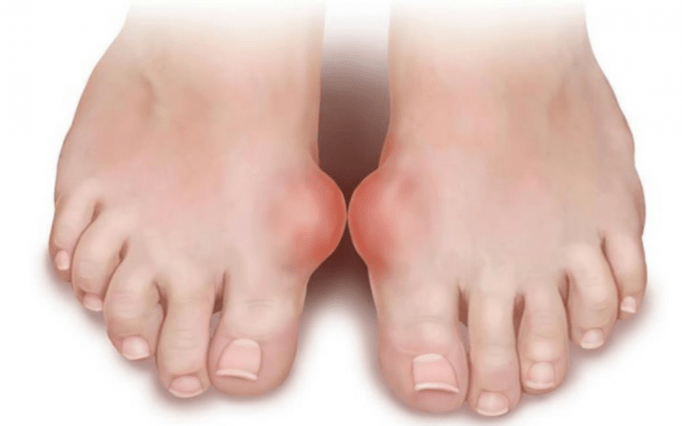deformacja stopy jako przyczyna pojawienia się grzyba na nogach