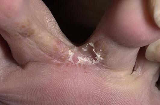 palce u stóp zaatakowane przez grzyby