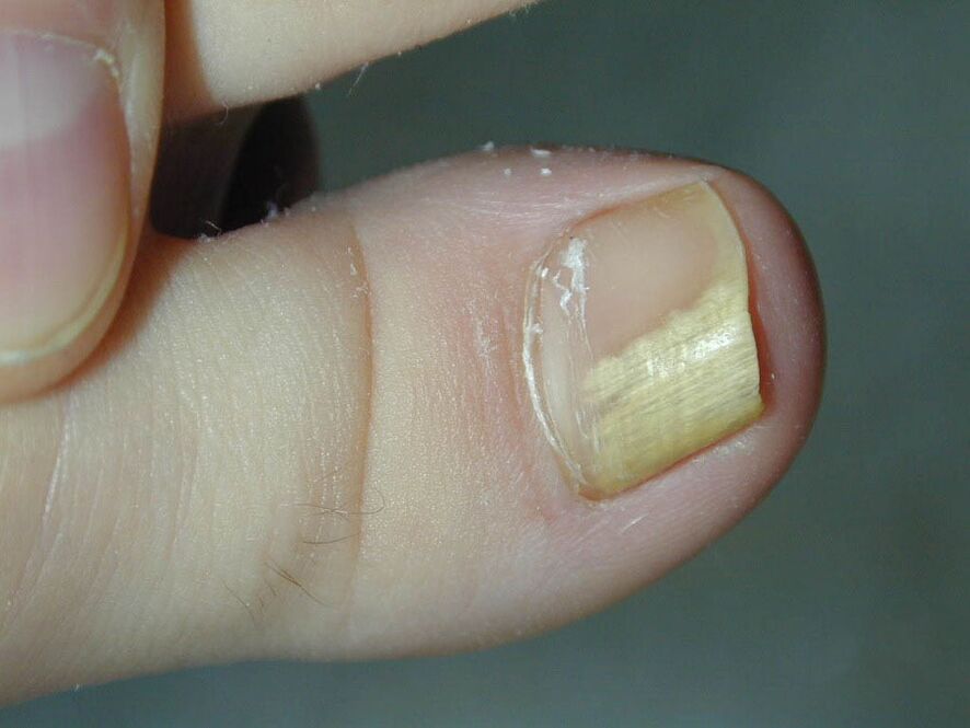 Objaw grzyba - przebarwienie paznokcia