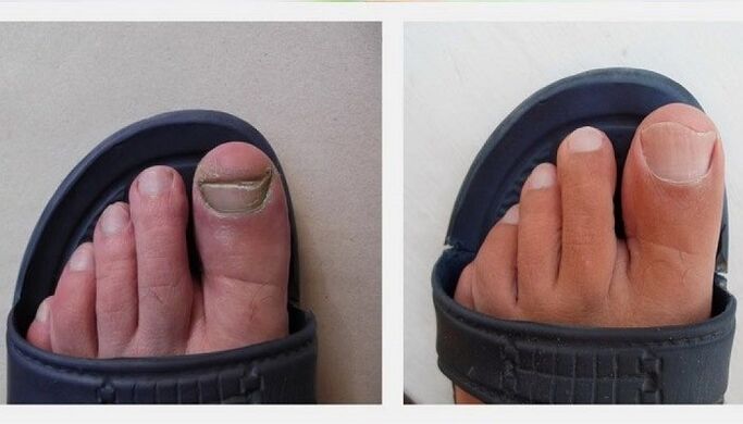 paznokcie u stóp przed i po leczeniu grzyba octem jabłkowym