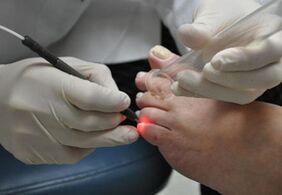 Laserowe leczenie grzybicy paznokci