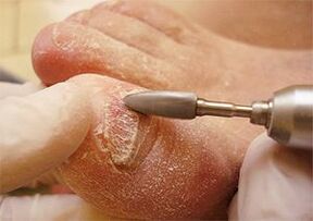 Mechaniczne usuwanie płytki paznokcia z powodu grzybicy paznokci