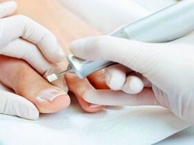 Pedicure leczniczy na grzybicę paznokci