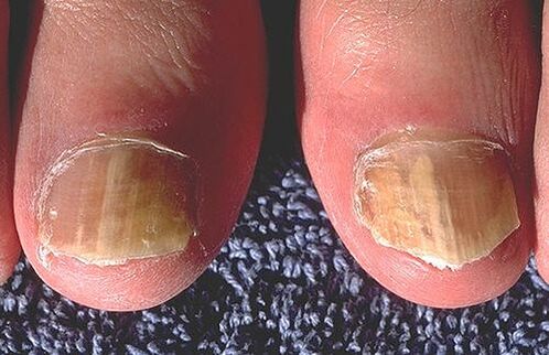 Paznokcie dotknięte dermatofitami